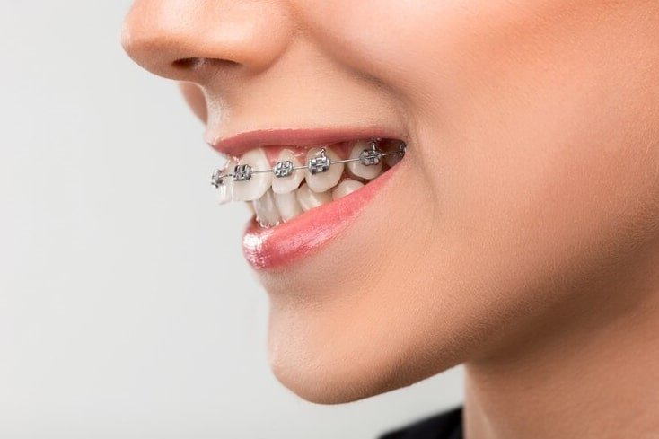 Dental Braces