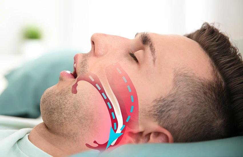 Should I Get Surgery for Sleep Apnea?
